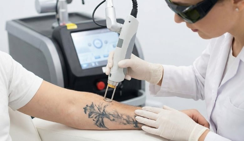 Tatuoinnin tai microbladingin poisto Pico-laserilla | Jopa -54 % | Turku -